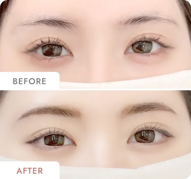 ファースト・アートメイク 銀座本院の眉アートメイク症例写真