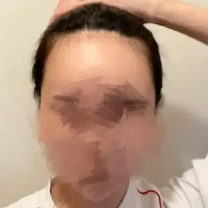 MOMOBIN（モモビン） ヘアラインアートメイクの施術前