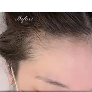 Yomil beauty ヘアラインアートメイクの施術前
