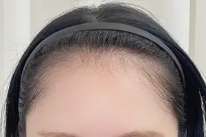 BROWNEE ヘアラインアートメイクの施術前