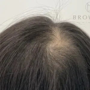 BROWNEE 頭皮アートメイク（SMP）の施術前