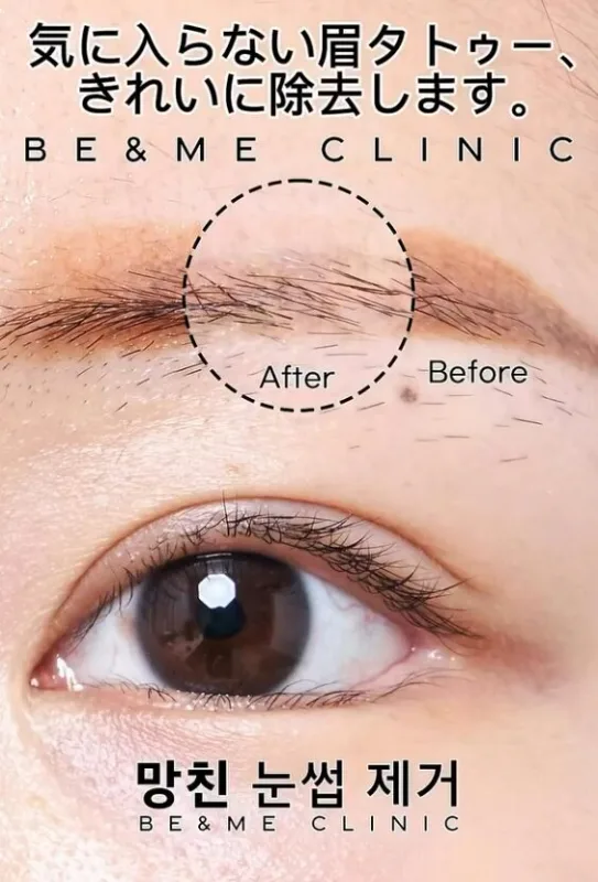 Be&Me Clinic 眉タトゥー除去の施術前後