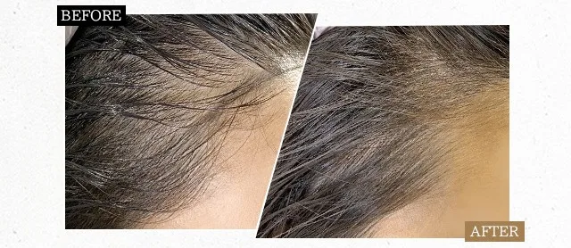 ヘアラインアートメイク ビフォーアフター