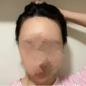 MOMOBIN（モモビン） ヘアラインアートメイクの施術後