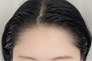 BROWNEE ヘアラインアートメイクの施術後