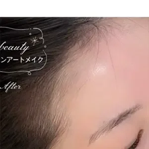 Yomil beauty ヘアラインアートメイクの施術後