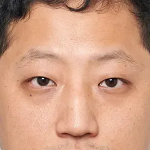 Be&Me Clinic 眉アートメイクの施術前