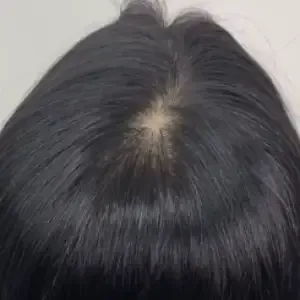 BROWDOLL ヘアラインアートメイクの施術前