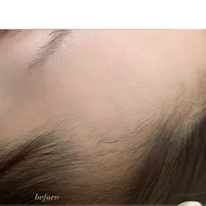 IRO ARTMAKE ヘアラインアートメイクの施術前