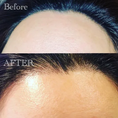 ヘアライン（生え際）アートメイクの施術前後