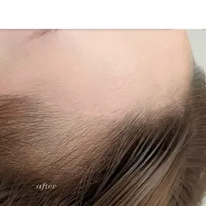 IRO ARTMAKE ヘアラインアートメイクの施術後
