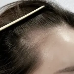 BROWDOLL ヘアラインアートメイクの施術前