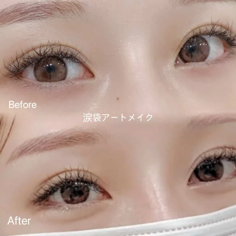 BLINK STUDIO 明洞店 涙袋アートメイクの施術前後の比較