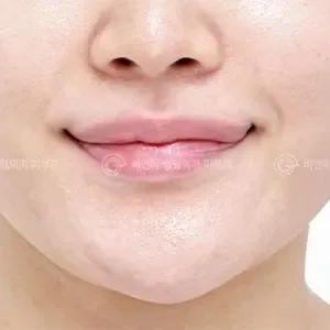 Be&Me Clinic リップアートメイクとえくぼ形成の施術前