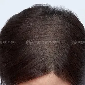 Be&Me Clinic 頭皮アートメイク（SMP）の施術後