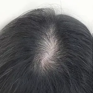Delumina Beauty 江南店 ヘアラインアートメイクの施術前