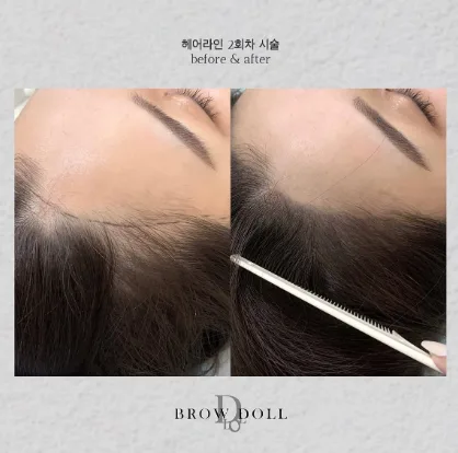 BROWDOLL ヘアラインアートメイクの施術前後の比較