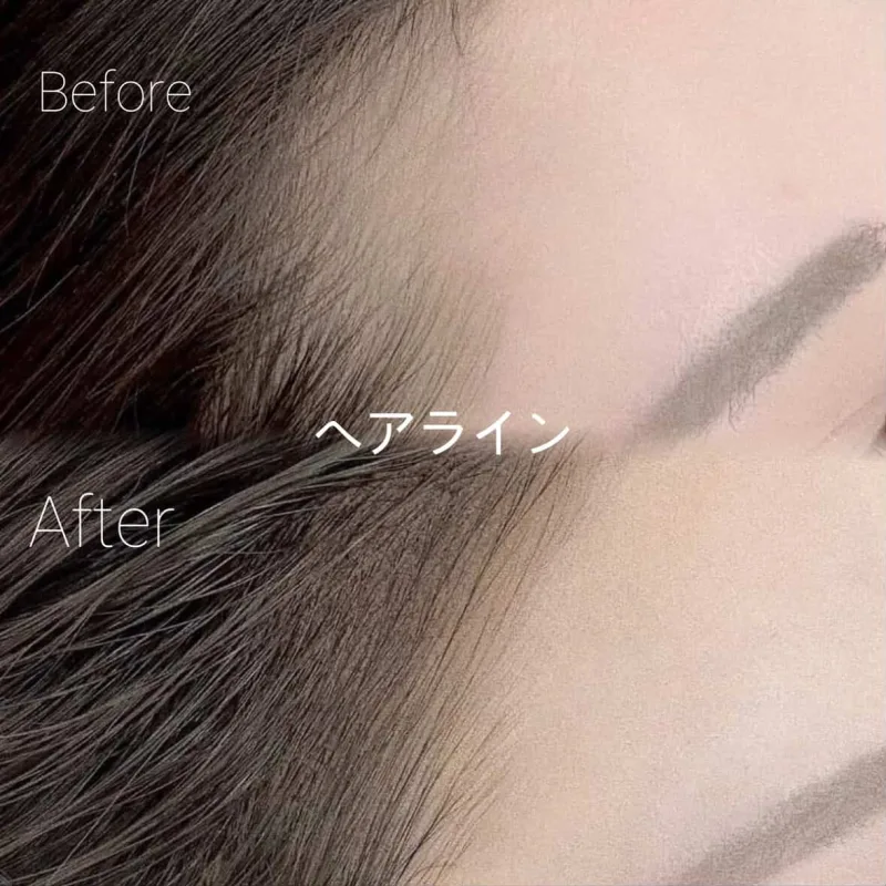 BLINK STUDIO 弘大店 ヘアラインアートメイクの施術前後の比較