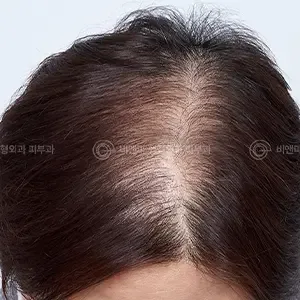 Be&Me Clinic 頭皮アートメイク（SMP）の施術前