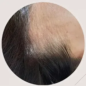 Delumina Beauty 江南店 ヘアラインアートメイクの施術前